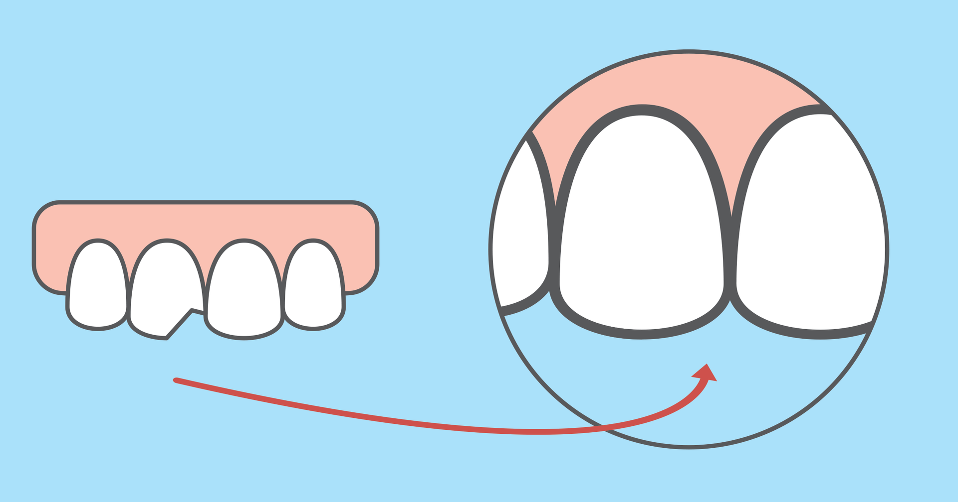can a chipped tooth grow back