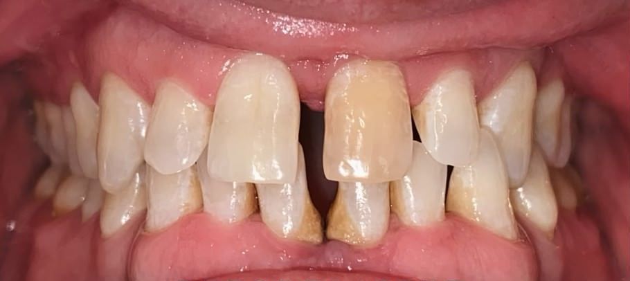 A close up of a person 's teeth with a missing tooth.