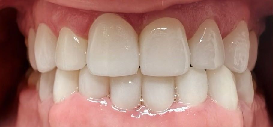 A close up of a person 's teeth with white teeth.