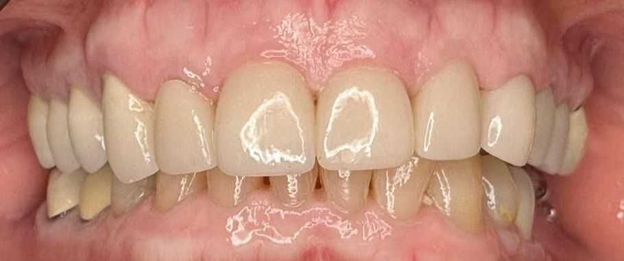 A close up of a person 's teeth with white teeth.