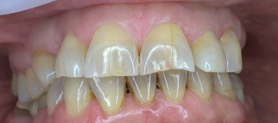 A close up of a person 's teeth with a broken tooth.