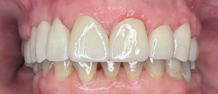 A close up of a person 's teeth with white teeth.