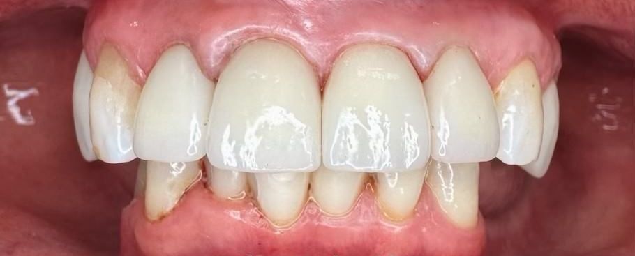 A close up of a person 's teeth with white teeth.