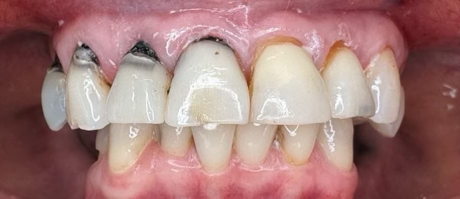 A close up of a person 's teeth with a lot of stains on them.