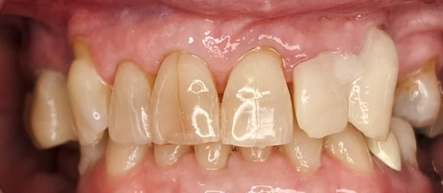 A close up of a person 's teeth with a lot of white spots on them.