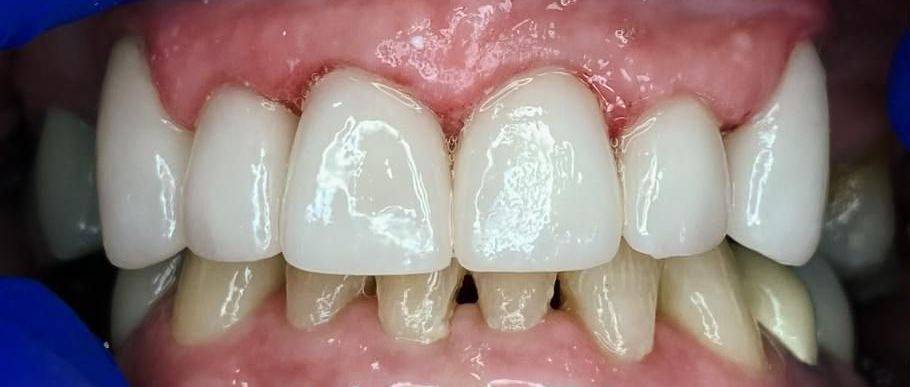 A close up of a person 's teeth with a blue glove on.