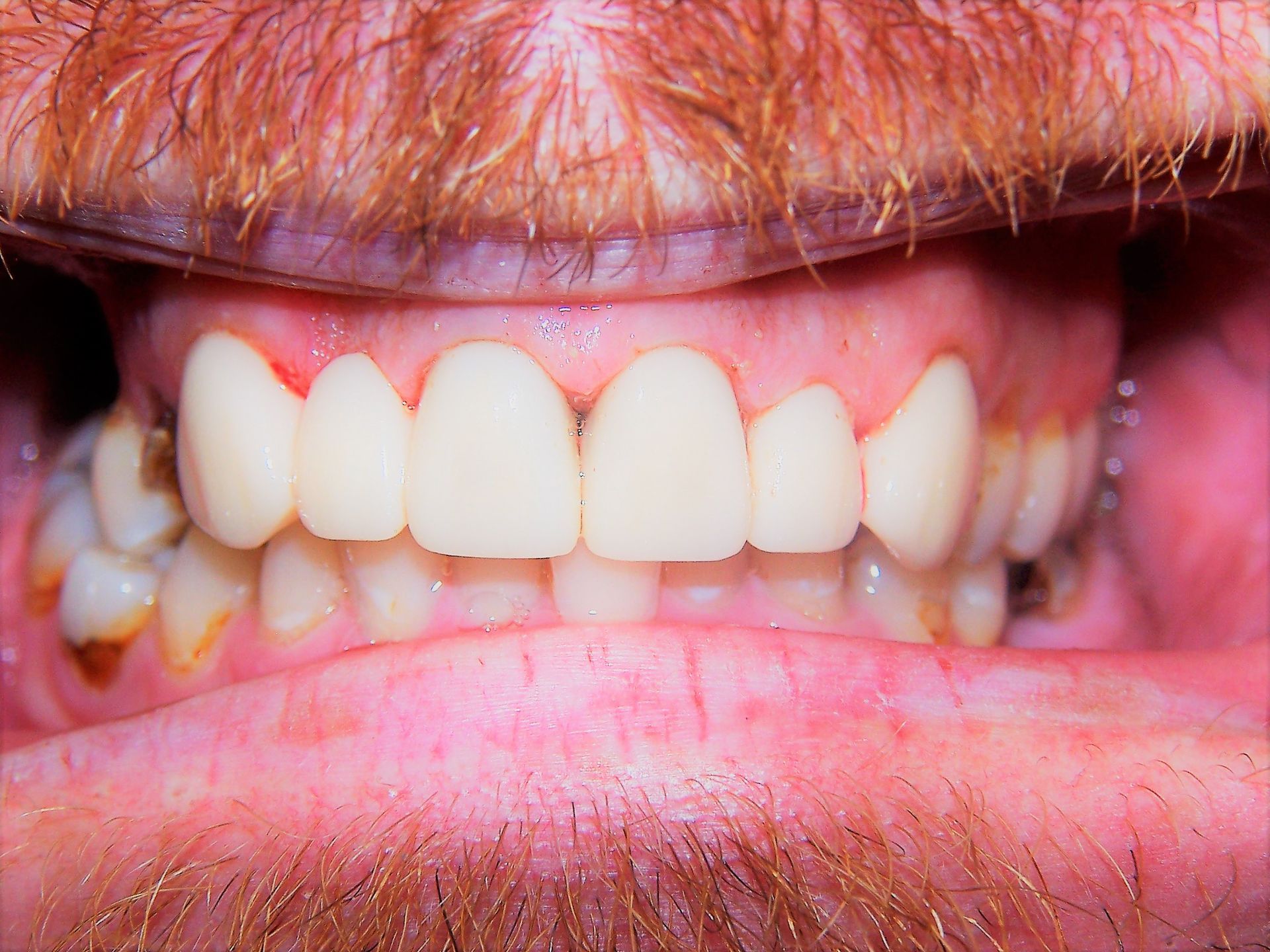 After Dental Crowns