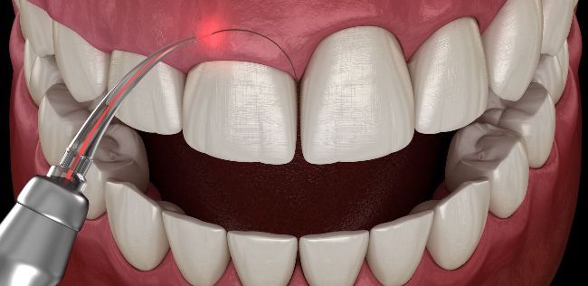 gingivectomy example