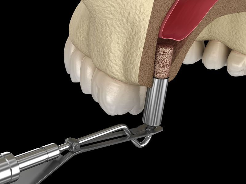 Example of sinus lift