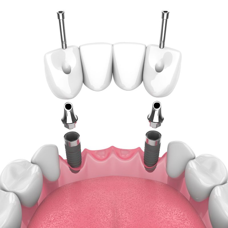 A 3d rendering of a dental bridge being installed in a mouth.