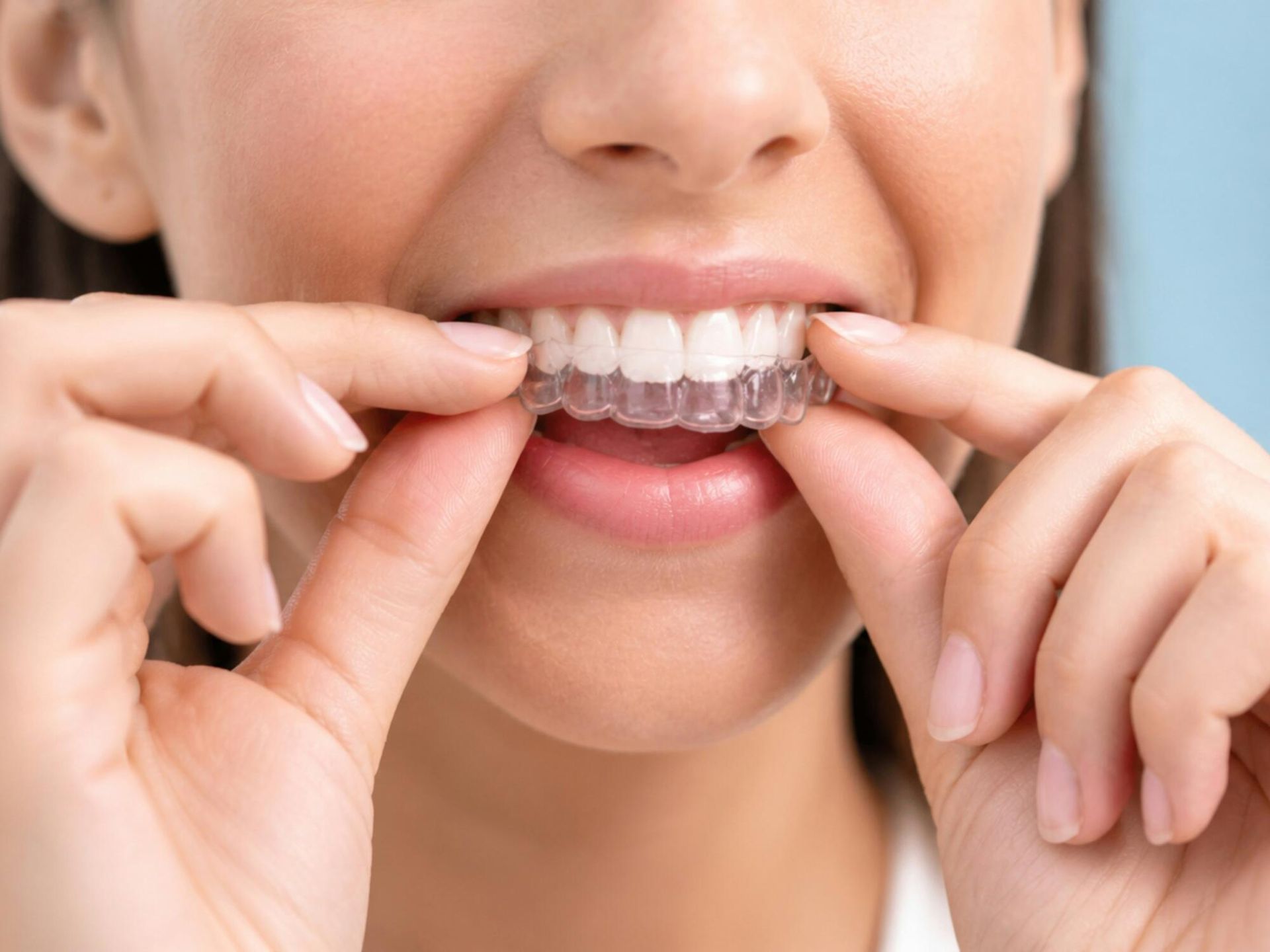 Person fitting clear dental aligners over their teeth