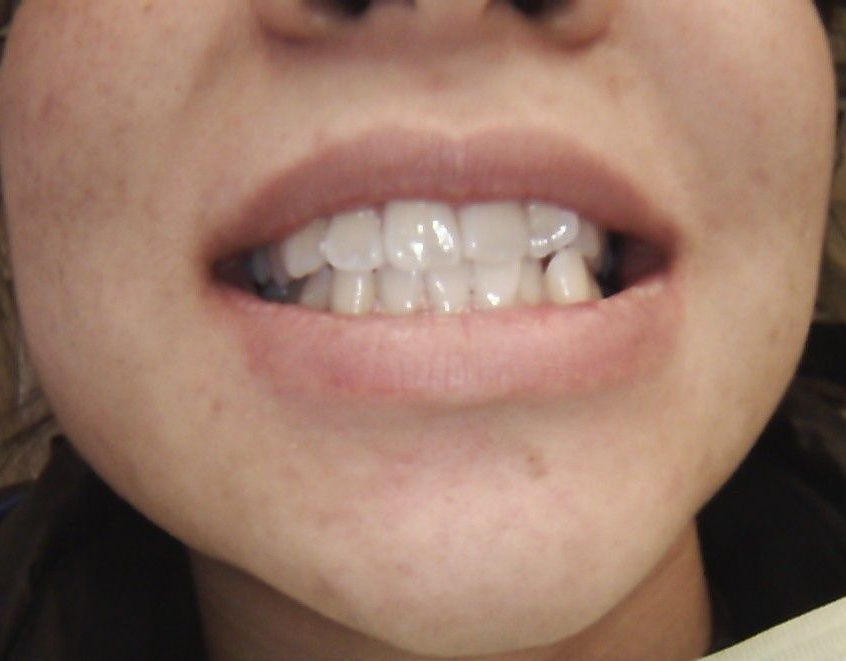 Close-up of a person's mouth showing teeth. Teeth are white and slightly misaligned.