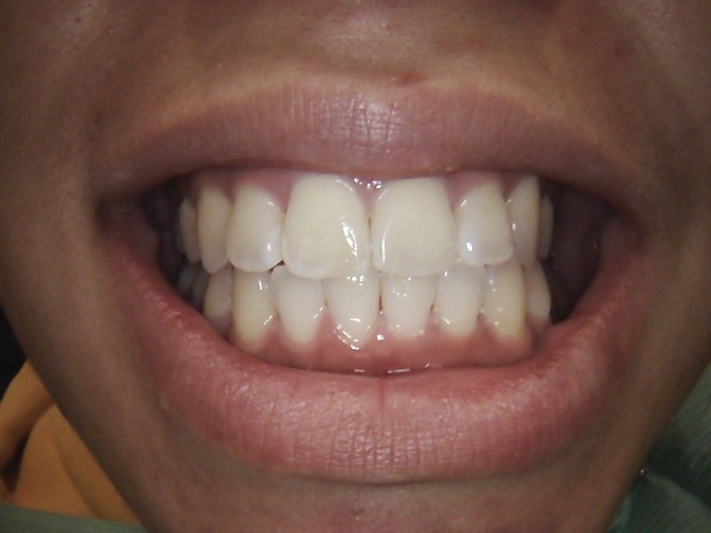 Close-up of a person's teeth, showing a smile. Teeth are white; gums are pink; lips are slightly parted.