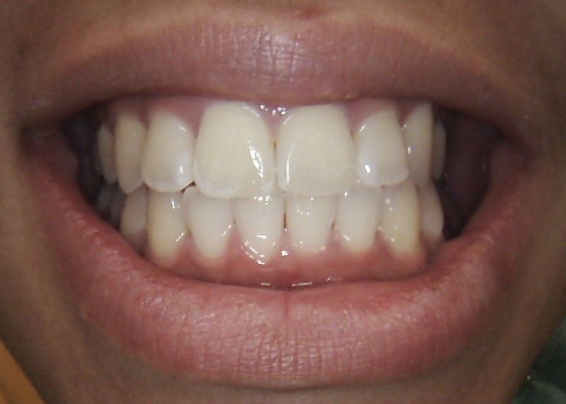 Close-up of a person's teeth, showing a smile. Teeth are white; gums are pink; lips are slightly parted.