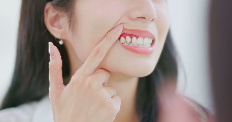 Woman pointing to her gums, showing teeth.