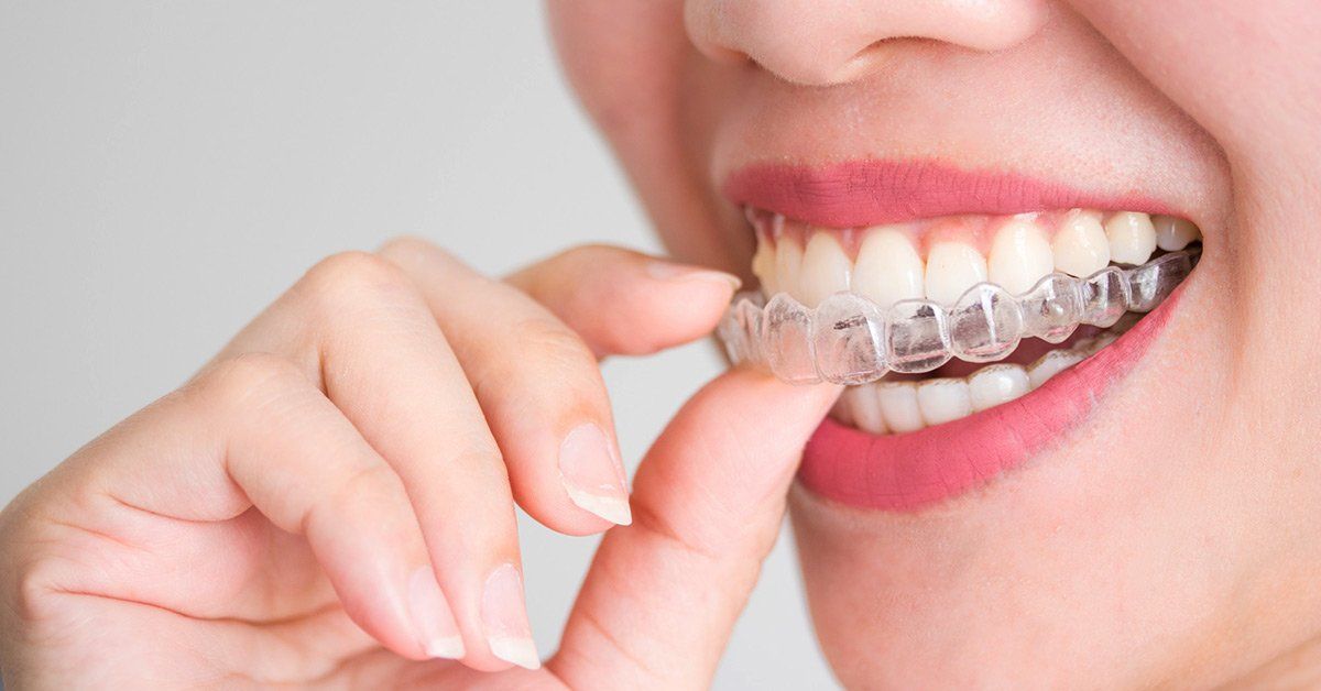 Straight Teeth Direct Pricing - Clear aligners cost made simple