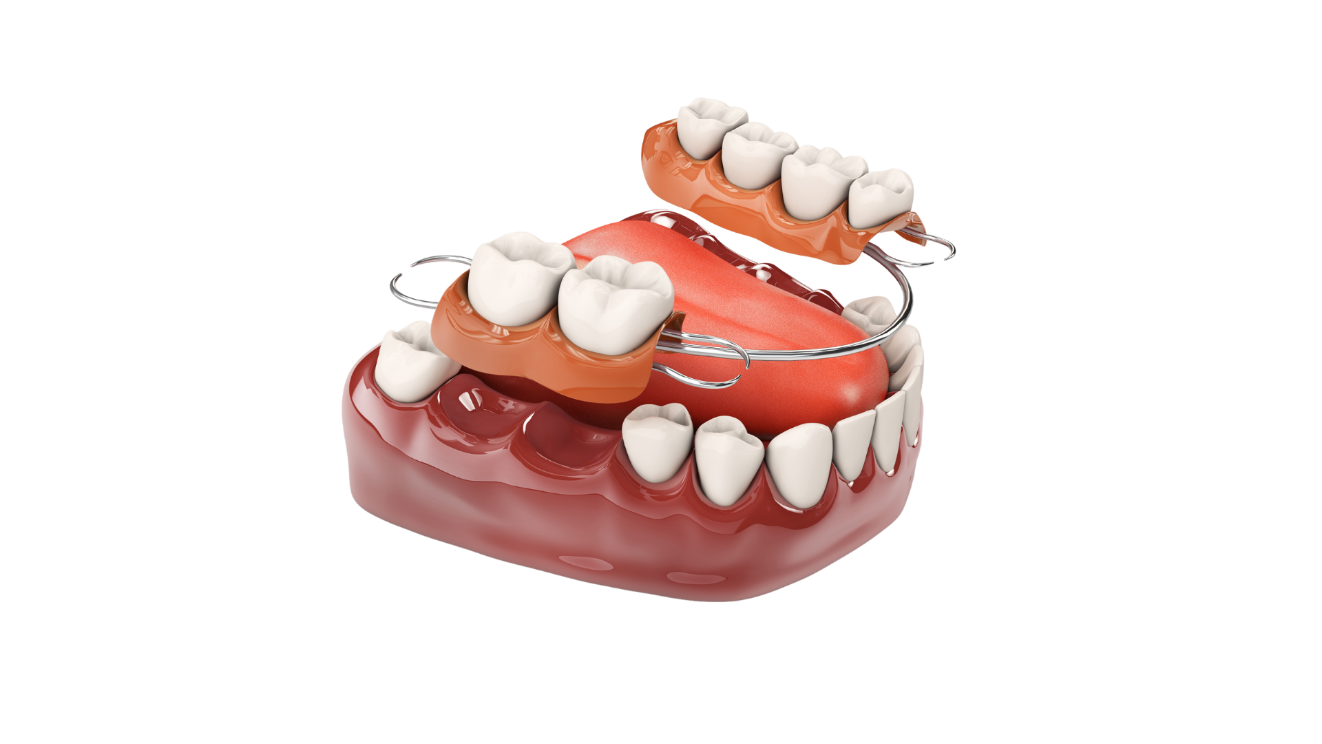 Image of a partial denture