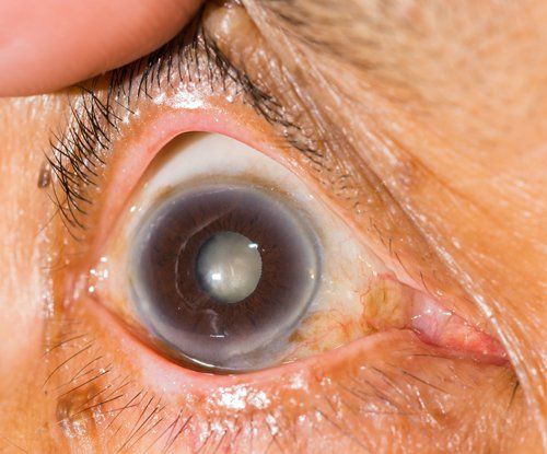 Cataracts in the eye