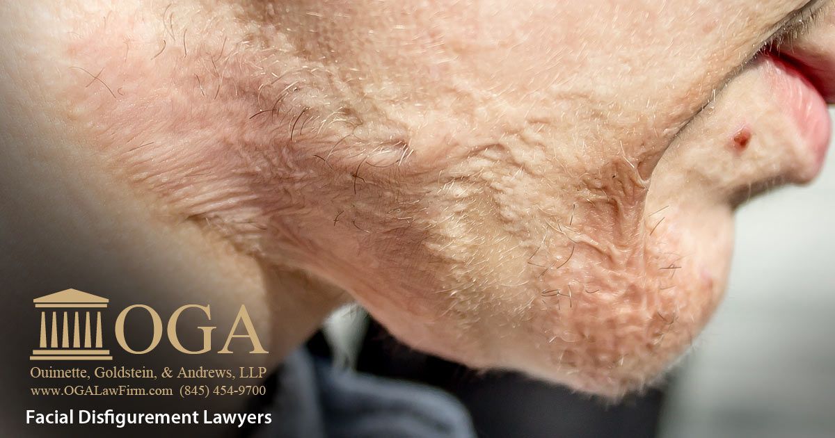 Facial Disfigurement Lawyers NY - Workers' Compensation Law Firm, OGA