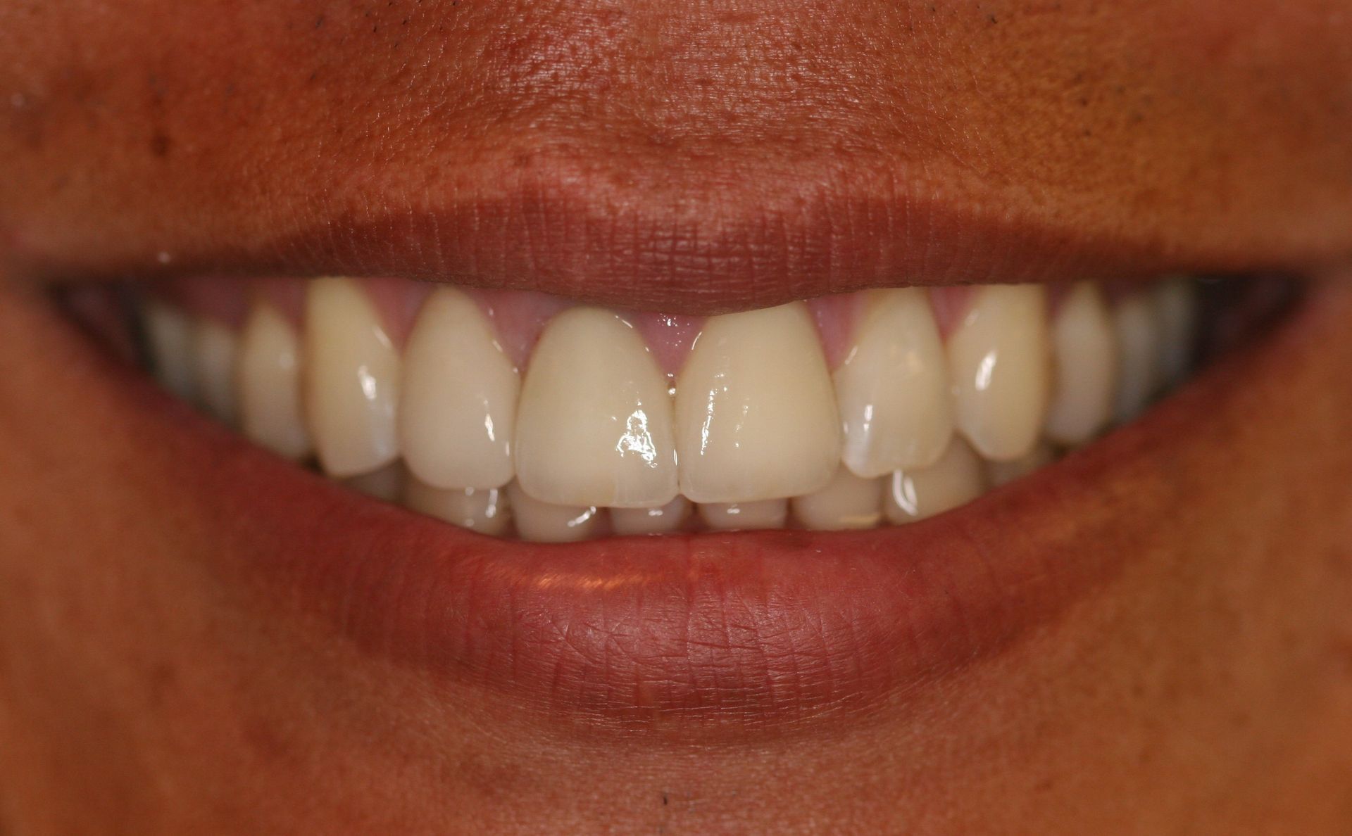 Michael Yang DDS - crowns