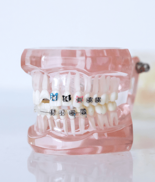 Aparelho dentário, ortodontia, dentes alinhados, aparelho transparente Aparelho fixo convencional, Aparelho fixo auto-ligável, Aparelhos estéticos, Ortodontia lingual, Alinhadores invisíveis, Ortopedia facial, Contenções, Distalizadores e Expansores de Maxilares.