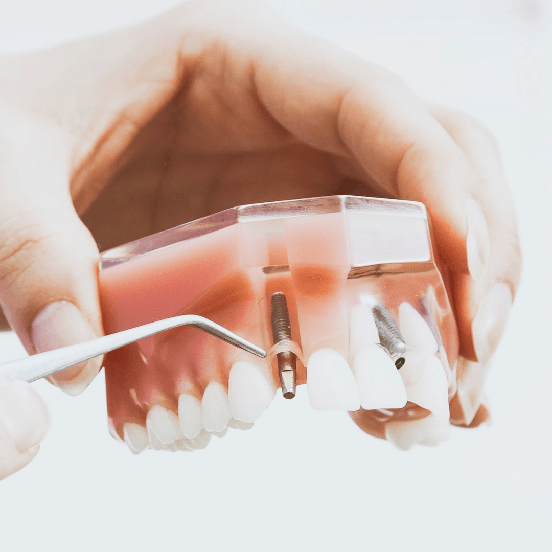 Implante dentário, Implantes, Próteses dentárias, Próteses Fixas, Próteses Removíveis