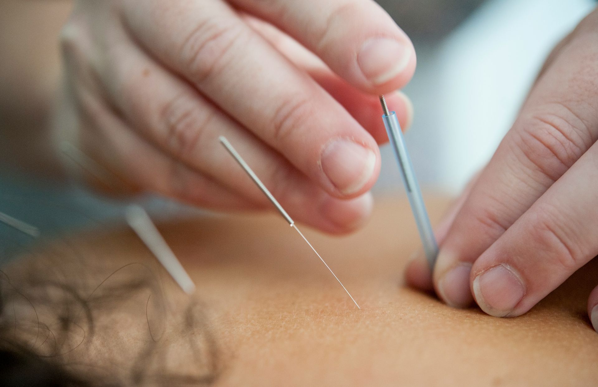 Hands performing acupuncture on a person's back; needles inserted into skin.