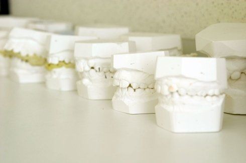 calchi dentari in gesso