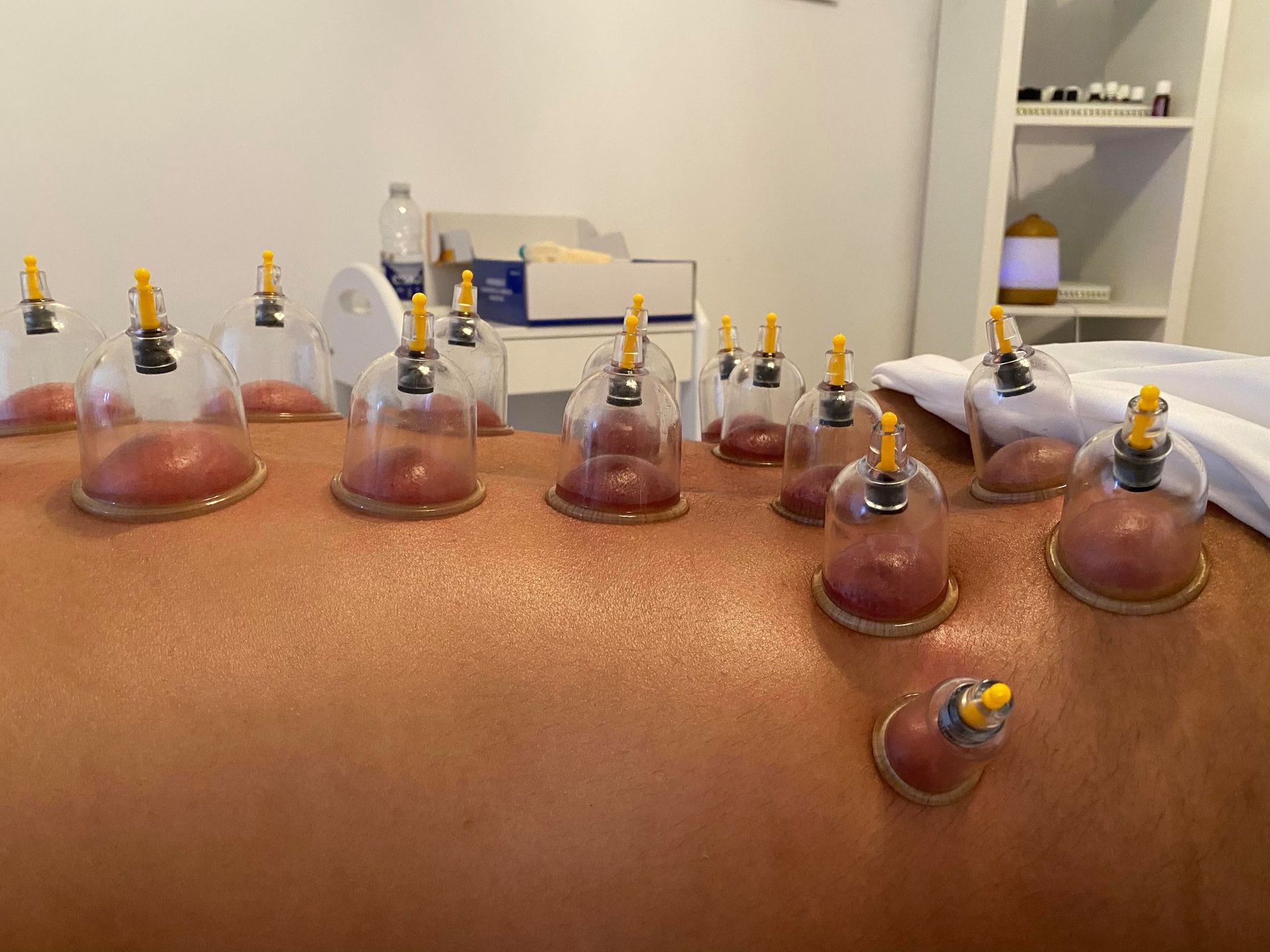 Ventouses posées sur le dos d'une personne lors d'une séance de ventouses. Les ventouses sont transparentes et certaines présentent une décoloration.