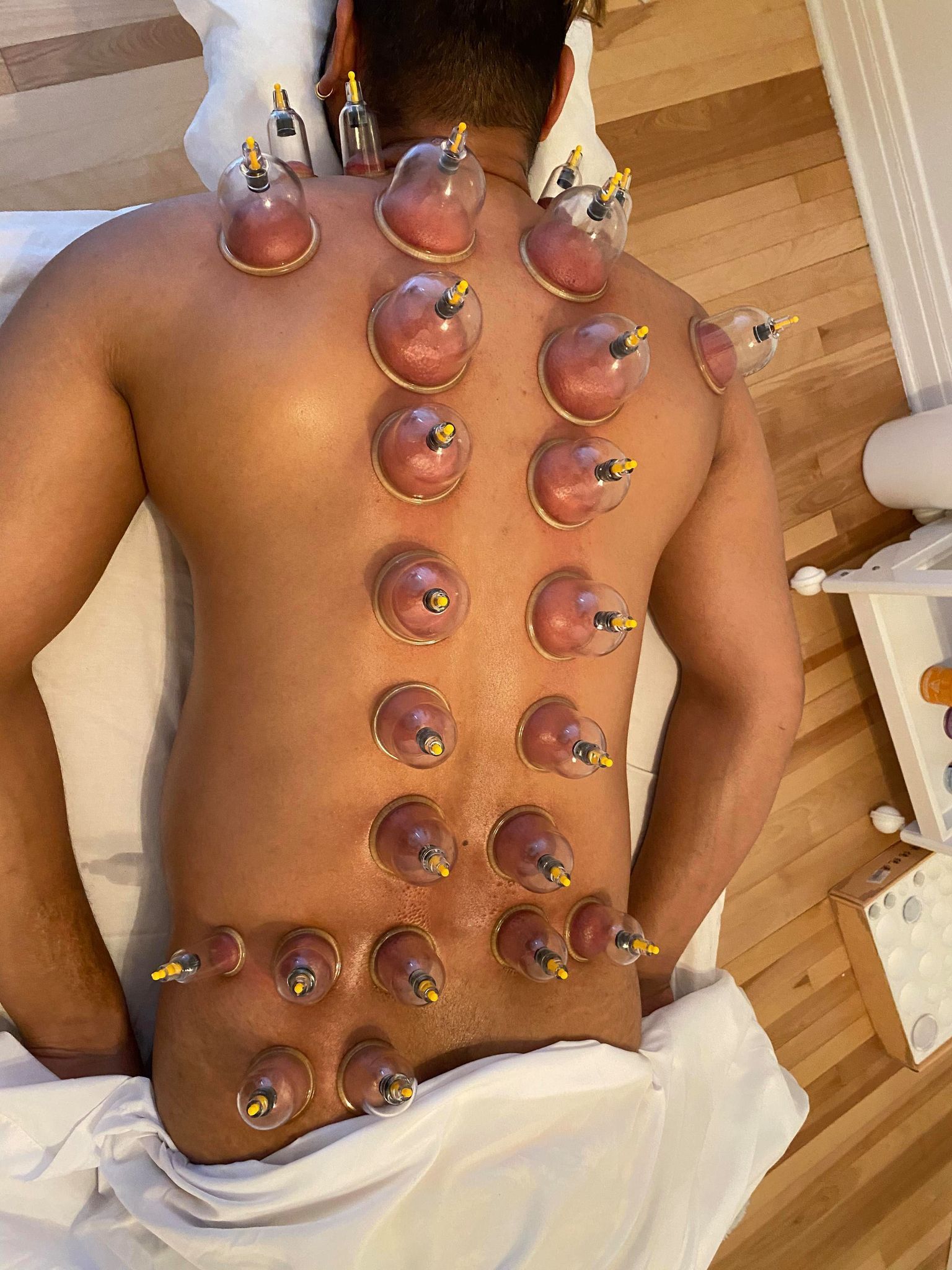 Le dos d'une personne est recouvert de ventouses thérapeutiques. Elle est allongée face contre terre sur une table de traitement.