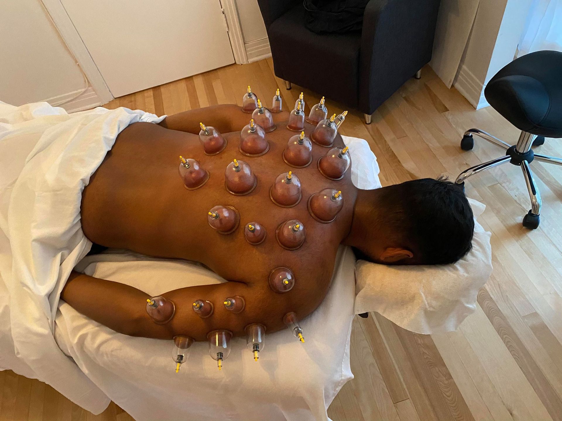 Personne allongée sur le ventre, le dos soumis à la thérapie par ventouses. Ventouses transparentes à embouts jaunes.