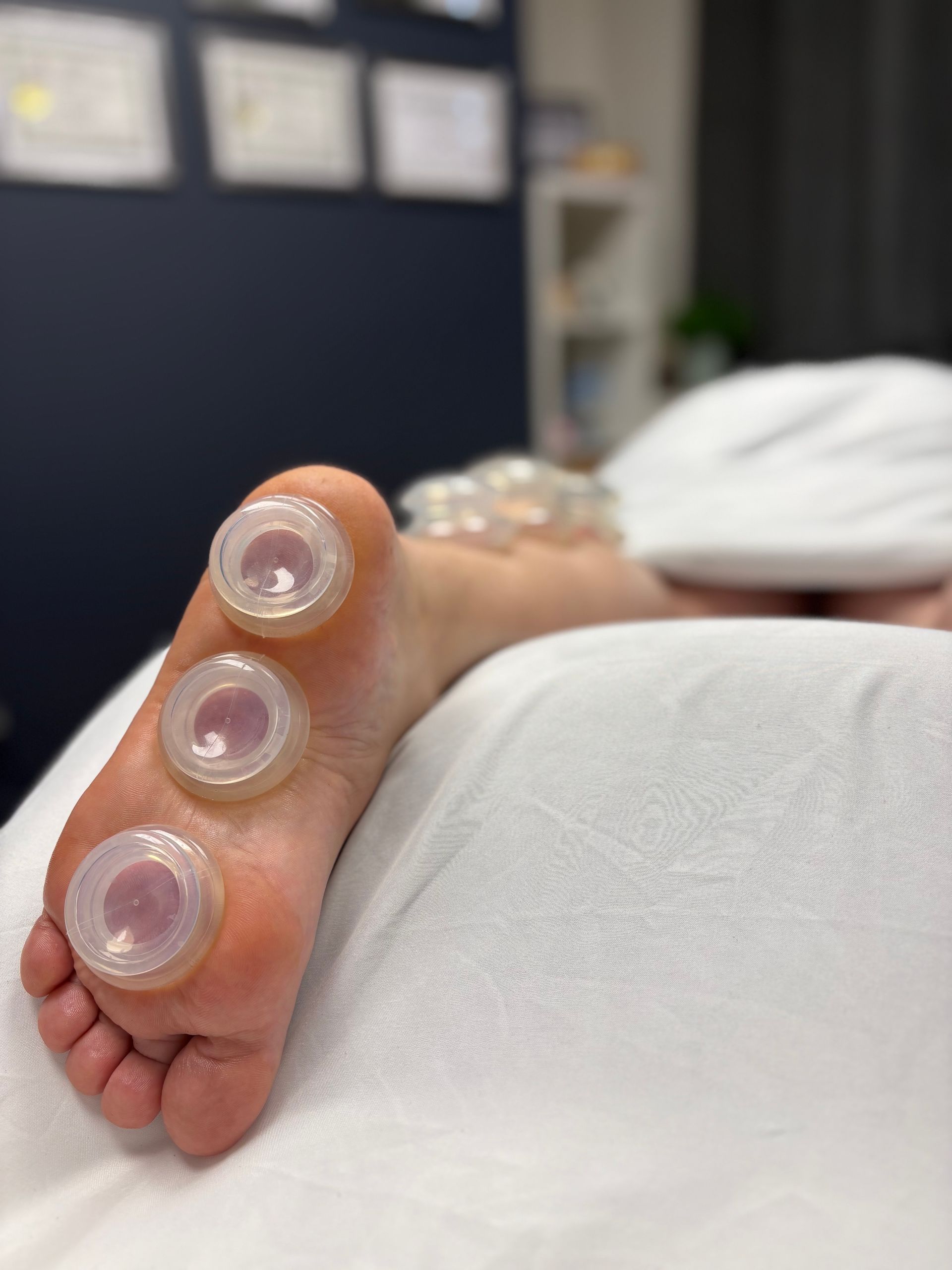 Pied avec trois ventouses thérapeutiques sur la plante du pied. Serviette blanche et arrière-plan flou.