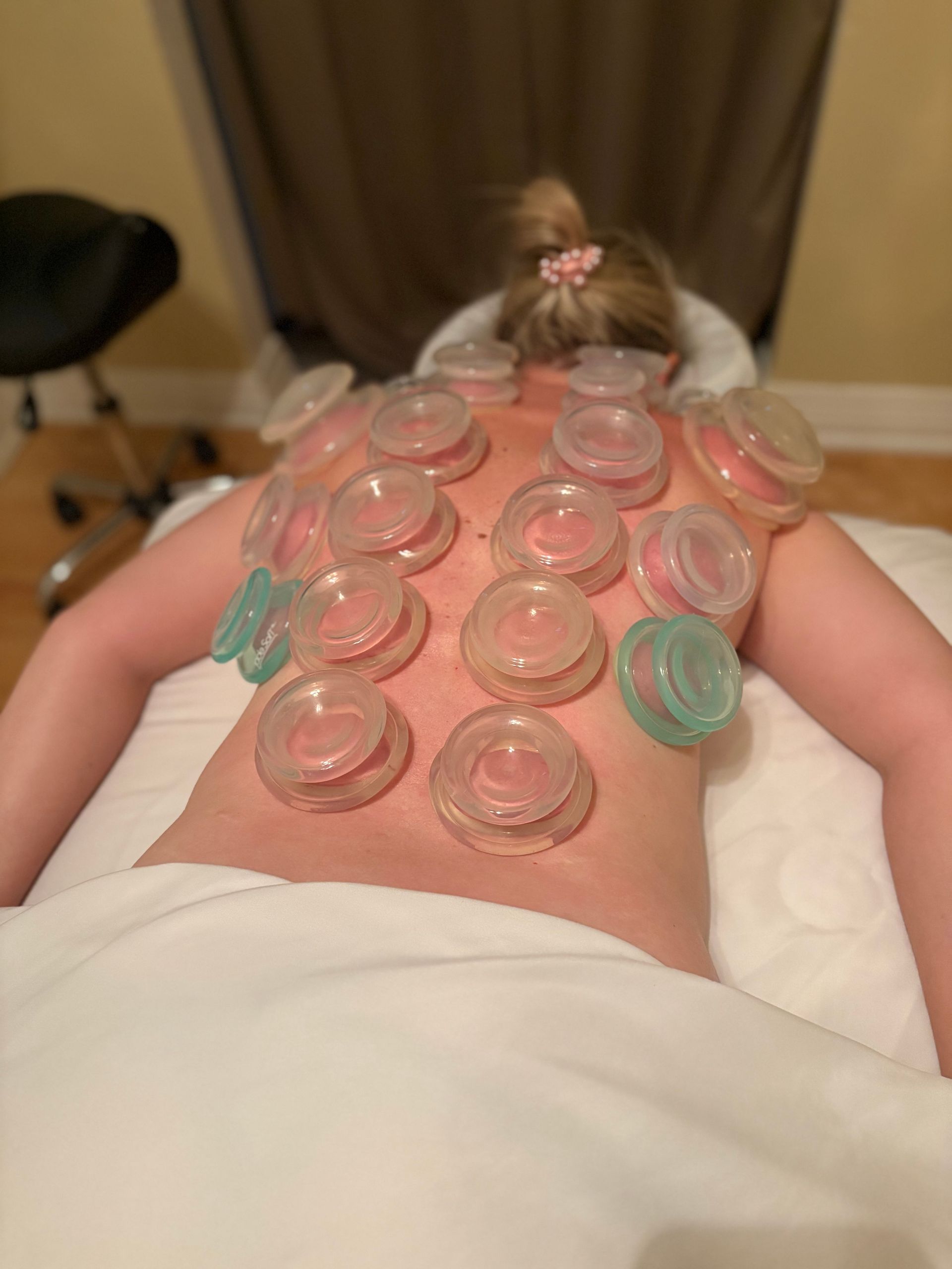 Femme allongée face contre terre sur une table de massage avec une thérapie par ventouses appliquée sur son dos.