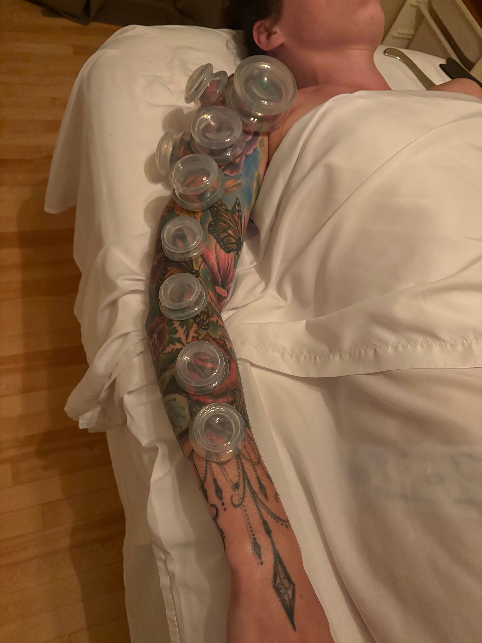 Une personne portant des ventouses sur le bras pour une thérapie par ventouses sur une table de massage. Bras tatoué visible.
