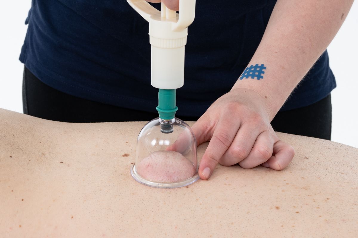 Une personne utilisant une ventouse sur le dos d'une personne ; poignée en plastique blanc, tasse transparente, tatouage bleu.