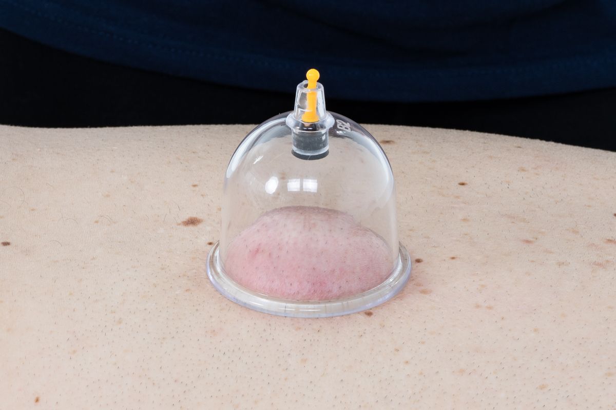 Un appareil de thérapie par ventouses transparentes sur le dos d'une personne ; l'aspiration provoque une décoloration rosâtre.