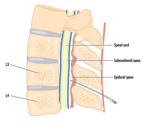 cervical epidural