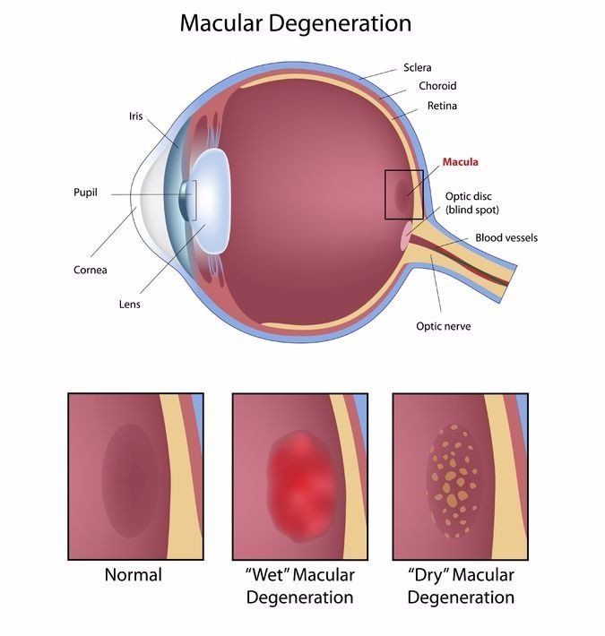 illustrative chart showing a normal macula, a macula affected by wet macular degeneration, and a macula affected by dry macular degeneration