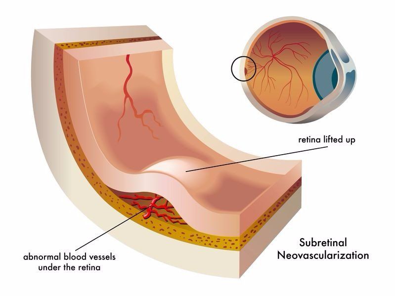 illustration of abnormal vessel growth seen in the wet form of macular degeneration