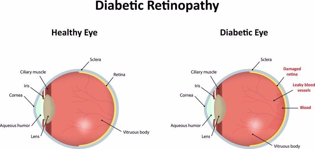 photo showing a diagram of a healthy eye vs an eye with diabetic damage