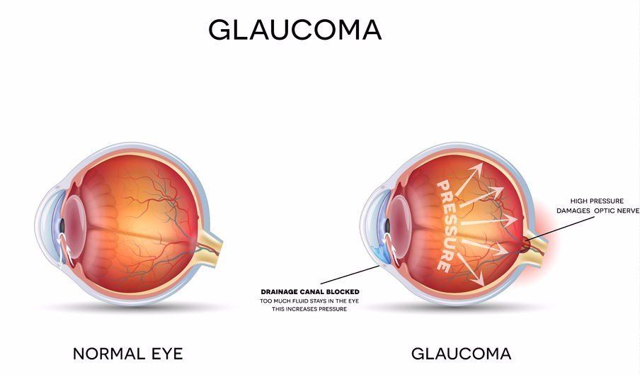 A diagram of a normal eye and a glaucoma eye.