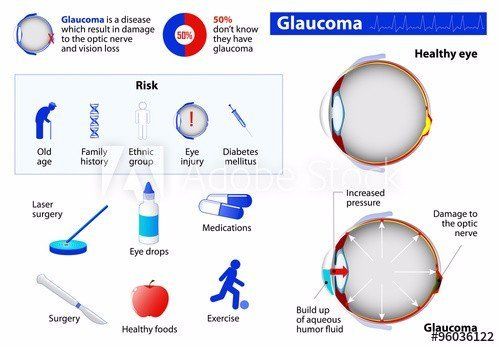 photo of a chart showing a healthy eye vs an eye with glaucoma with risk factors and treatment options