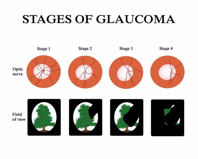 illustration showing the progression of vision loss and optic nerve damage in glaucoma