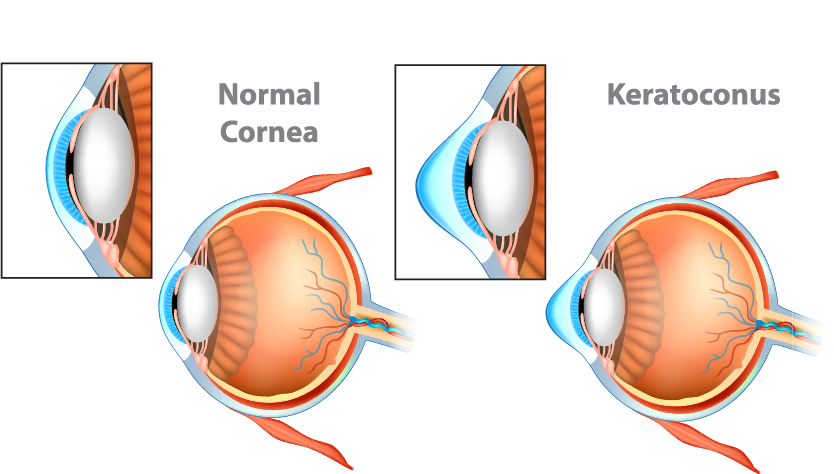 normal cornea and cornea with Keratoconus