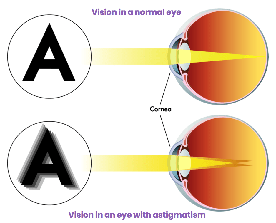 Vision in a normal eye and in an eye with astigmatism