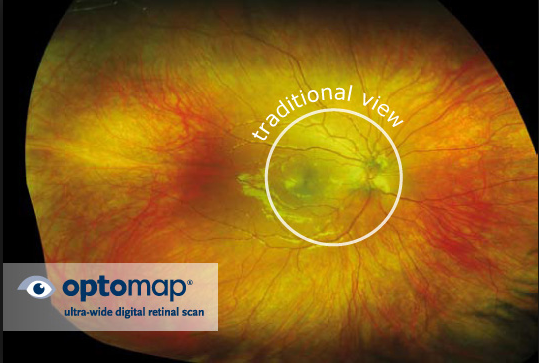 retina scan with Optomap