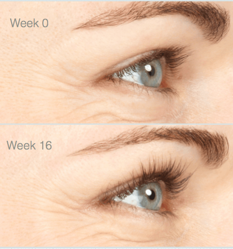 eyelashes before and after 16 week treatment with Latisse