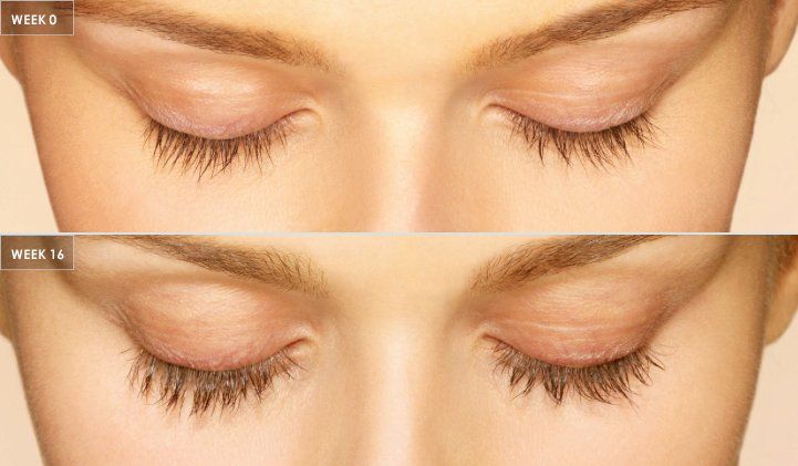 woman's eyelashes before and after 16 week treatment with Latisse