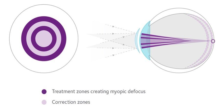 Graphic showing how MiSight corrects myopia