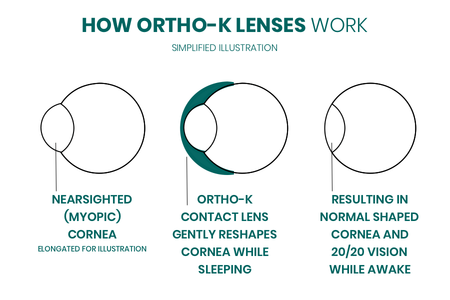 How ortho-k works illustration